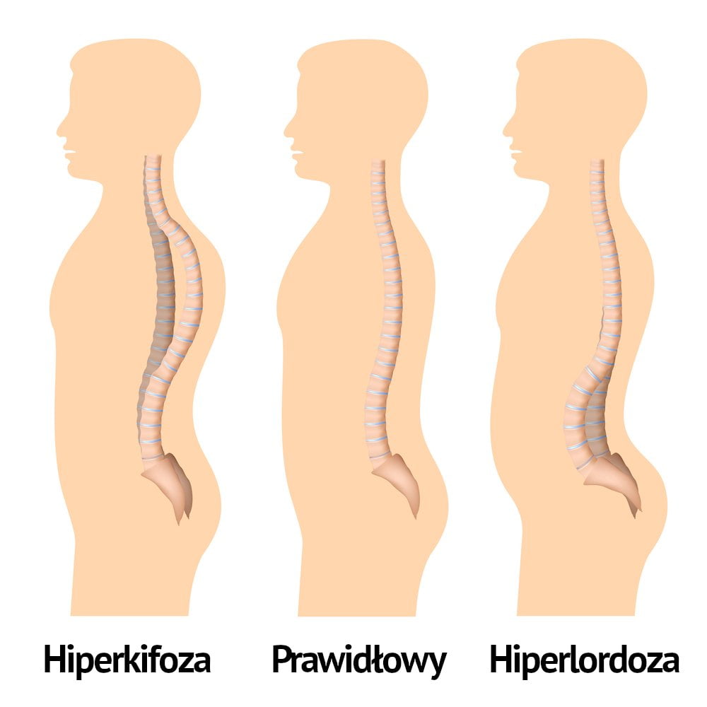 Hiperlordoza przyczyny