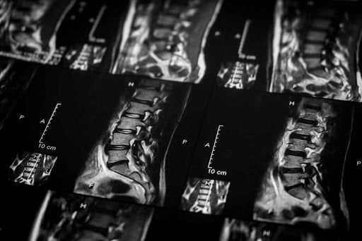 Rezonans magnetyczny kręgosłupa