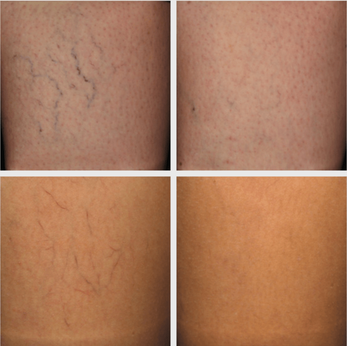 Skleroterapia przed i po