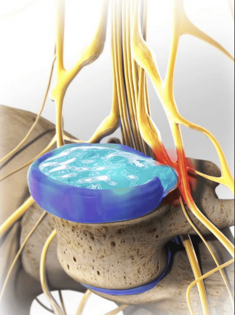 Dehydratacja krążka międzykręgowego
